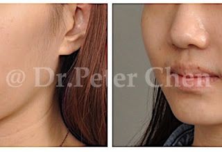 療程效果因人而異，上圖為上顎骨突出合併下顎骨後縮案例實際進行正顎手術術後之成效。