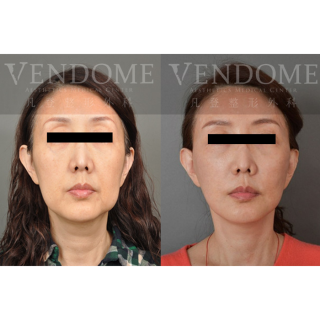 50歲女性 進行中下臉拉皮手術 合併處理下臉部疤痕組織 細紋/木偶紋與法令紋得到改善 解決下臉部疤痕組織造成的不對稱 原本長寬臉型 塑造成黃金比例V臉