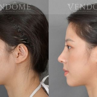 療程效果因人而異，上圖為該案例實際進行隆鼻手術術後之成效