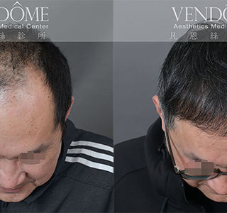 頂部落髮是許多中年男性最常見的禿髮問題，嚴重時會造成頭頂明顯稀疏甚至光禿，影響外貌自信。透過植髮手術在頭頂區域補植毛囊，增加髮量與密度，讓頭頂頭髮更加豐厚完整。