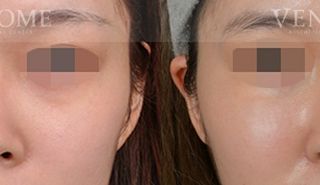 療程效果因人而異，上圖為該案例實際進行隆鼻手術術後之成效