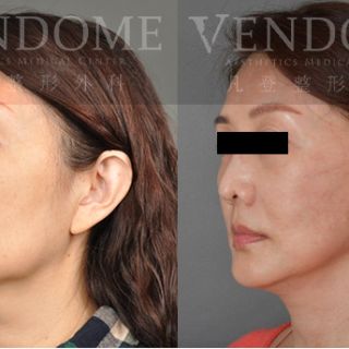 50歲女性 進行中下臉拉皮手術 合併處理下臉部疤痕組織 細紋/木偶紋與法令紋得到改善 解決下臉部疤痕組織造成的不對稱 原本長寬臉型 塑造成黃金比例V臉