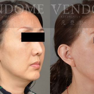 50歲女性 進行中下臉拉皮手術 合併處理下臉部疤痕組織 細紋/木偶紋與法令紋得到改善 解決下臉部疤痕組織造成的不對稱 原本長寬臉型 塑造成黃金比例V臉