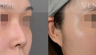 療程效果因人而異，上圖為該案例實際進行隆鼻手術術後之成效