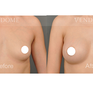 療程效果因人而異，上圖為該案例實際進行果凍矽膠隆乳手術後之成效