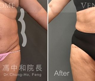 馮中和院長在執行鑽石形腹部拉皮時，會將手術疤痕設計在內褲、褲子可完美隱藏的位置，且疤痕通常在半年到一年之間會逐漸淡化，讓患者不用為了疤痕而苦惱。
