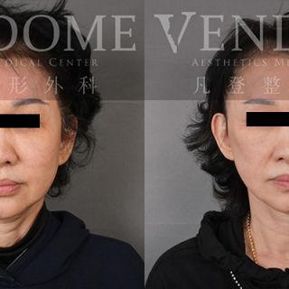 65歲女性 中下臉拉皮合併頸部拉皮合併補脂 解決鬆弛堆疊的下巴皺紋 改善法令紋與木偶紋 膨潤蘋果肌與強化整體中下臉線條