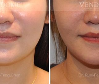 療程效果因人而異，上圖之案例是在接受正顎手術的同時，將下顎骨角做適當的修飾，把比較大的下顎骨角移除，透過正顎手術校正戽斗，並以削骨手術打造更柔順的下顎線條。