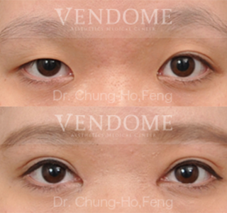 療程效果因人而異，上圖為該案例實際進行割雙眼皮手術、開眼頭手術、提眼瞼肌手術術後之成效