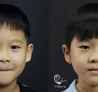 療程效果因人而異，上圖為7歲小朋友實際進行單側(右耳)小耳症手術術後之成效。
