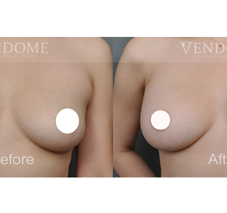 療程效果因人而異，上圖為該案例實際進行果凍矽膠隆乳手術後之成效