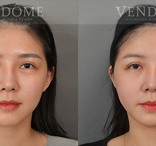 療程效果因人而異，上圖之案例為外傷造成頭部太陽穴凹陷，透過削骨手術合併自體脂肪填補，已恢復對稱理想臉型比例。