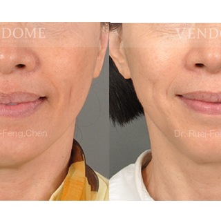 療程效果因人而異，上圖為該案例實際進行自體脂肪填補手術術後之成效