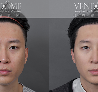 隨著年齡增長，髮際線逐漸上移，讓額頭顯得過於寬大或不均勻。透過植髮手術將髮際線往前調整，重新塑造自然的髮際輪廓，讓整張臉看起來更年輕、有精神。