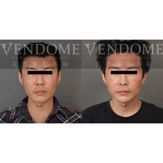 35歲男性 進行拉皮手術合併臉部補脂 強化下顎線線條以及顴骨立體感 並且解決淚溝造成視覺上的疲倦感