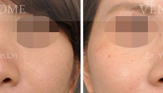 療程效果因人而異，上圖為該案例實際進行隆鼻手術術後之成效