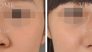 療程效果因人而異，上圖為該案例實際進行隆鼻手術術後之成效