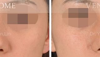 療程效果因人而異，上圖為該案例實際進行隆鼻手術術後之成效