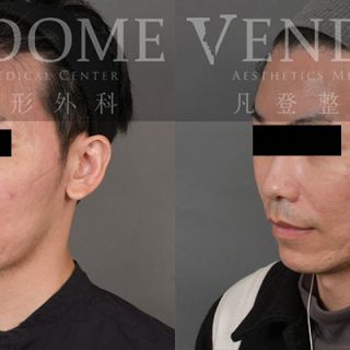43歲男性 進行全臉拉皮 (前額+中下臉拉皮) 合併補脂 補法令紋 以及縮鼻翼手術 解決眼袋與法令紋 並且縮鼻翼手術加上顴骨的飽滿度與下顎線線條 強化整體顏面立體感