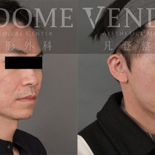 43歲男性 進行全臉拉皮 (前額+中下臉拉皮) 合併補脂 補法令紋 以及縮鼻翼手術 解決眼袋與法令紋 並且縮鼻翼手術加上顴骨的飽滿度與下顎線線條 強化整體顏面立體感