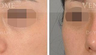 療程效果因人而異，上圖為該案例實際進行隆鼻手術術後之成效