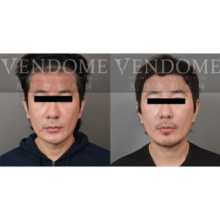 49歲男性 中下臉拉皮合併3D列印下巴手術 透過拉皮手術減少臉部法令/木偶紋 並且同時強化顴骨 下顎線立體度 輔以下巴手術 達到顏面黃金比例與理想 V-Line 與 E-Line