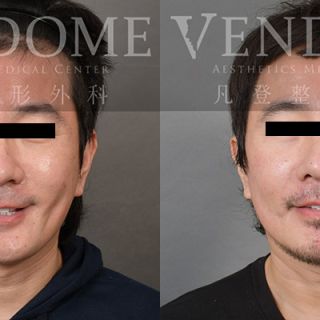 49歲男性 中下臉拉皮合併3D列印下巴手術 透過拉皮手術減少臉部法令/木偶紋 並且同時強化顴骨 下顎線立體度 輔以下巴手術 達到顏面黃金比例與理想 V-Line 與 E-Line