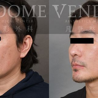 49歲男性 中下臉拉皮合併3D列印下巴手術 透過拉皮手術減少臉部法令/木偶紋 並且同時強化顴骨 下顎線立體度 輔以下巴手術 達到顏面黃金比例與理想 V-Line 與 E-Line