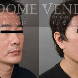 49歲男性 中下臉拉皮合併3D列印下巴手術 透過拉皮手術減少臉部法令/木偶紋 並且同時強化顴骨 下顎線立體度 輔以下巴手術 達到顏面黃金比例與理想 V-Line 與 E-Line