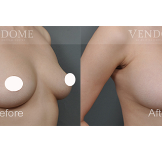 療程效果因人而異，上圖為該案例實際進行果凍矽膠隆乳手術後之成效