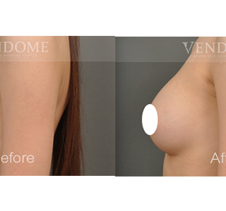 術前 A cup -> 術後 D cup 原本的上胸較無肉，但在接受魔滴隆乳後， 胸前呈現完美水滴狀，展現出更加完美的曲線。 療程效果因人而異，上圖為該案例實際進行果凍矽膠隆乳手術後之成效