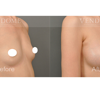 療程效果因人而異，上圖為該案例實際進行果凍矽膠隆乳手術後之成效