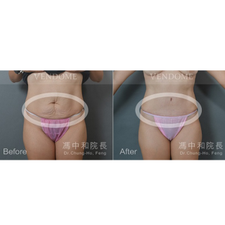 利用鑽石形腹部拉皮，除了幫X小姐改善了鬆垮的肚皮以外，也特地針對她鼠蹊部兩側的皮膚下墜一併做了提拉，可以發現她的腹部不僅變得平坦了，肚臍的形狀也在手術中一併改善，從一字型變回小巧橢圓形，手術疤痕也設計在內褲、褲子能夠剛好遮住的完美位置！