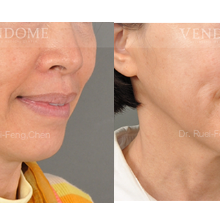 療程效果因人而異，上圖為該案例實際進行自體脂肪填補手術術後之成效