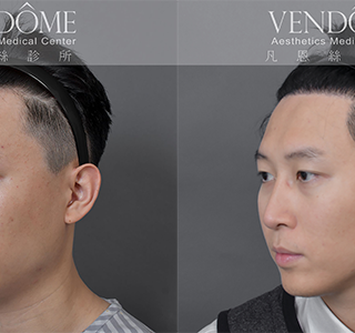 隨著年齡增長，髮際線逐漸上移，讓額頭顯得過於寬大或不均勻。透過植髮手術將髮際線往前調整，重新塑造自然的髮際輪廓，讓整張臉看起來更年輕、有精神。