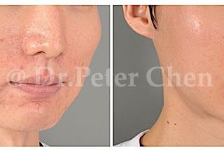 療程效果因人而異，上圖為案例實際進行下顎骨角削骨合併顴骨截骨內推術後之成效