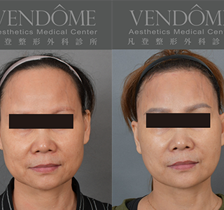 功能性前額拉皮可有效改善髮際線，微調額頭高度，使臉部比例更加好看