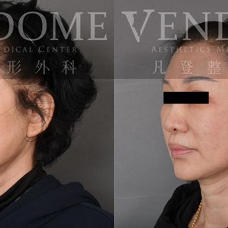 65歲女性 中下臉拉皮合併頸部拉皮合併補脂 解決鬆弛堆疊的下巴皺紋 改善法令紋與木偶紋 膨潤蘋果肌與強化整體中下臉線條