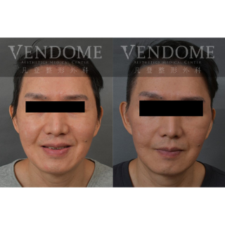 55歲男性 進行中下臉拉皮手術 清除下臉部矽膠 合併補脂 清除舊手術留存的矽膠注射物 進行整體面部拉提 改善法令紋 強化下巴線條 並且減少淚溝的視覺疲態