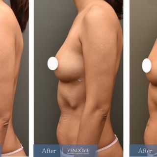 療程效果因人而異，上圖為B罩杯產後女性在做完自體脂肪隆乳之後​手術後一個月、手術後六個月成效