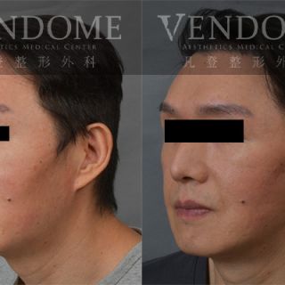 55歲男性 進行中下臉拉皮手術 清除下臉部矽膠 合併補脂 清除舊手術留存的矽膠注射物 進行整體面部拉提 改善法令紋 強化下巴線條 並且減少淚溝的視覺疲態