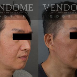 55歲男性 進行中下臉拉皮手術 清除下臉部矽膠 合併補脂 清除舊手術留存的矽膠注射物 進行整體面部拉提 改善法令紋 強化下巴線條 並且減少淚溝的視覺疲態