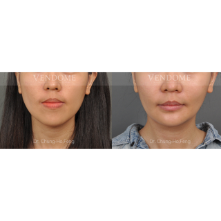 療程效果因人而異，28歲的M小姐因為第三級咬合不正 (戽斗)，臉型不對稱來診所做了正顎手術，上圖是M小姐在做完正顎手術術後2年追蹤