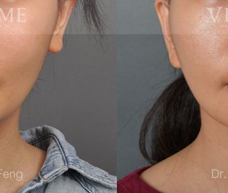 療程效果因人而異，28歲的M小姐，在做完正顎手術2年後，短寬臉型的她因中臉下垂的關係，讓他的臉型問題變得更是一覽無遺，上圖是M小姐在做完臉部年輕化拉皮手術術後1年追蹤