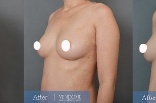 療程效果因人而異，上圖為C罩杯產後女性在做完自體脂肪隆乳之後​手術後一個月、手術後兩個月成效