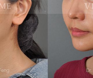 療程效果因人而異，28歲的M小姐，在做完正顎手術2年後，短寬臉型的她因中臉下垂的關係，讓他的臉型問題變得更是一覽無遺，上圖是M小姐在做完臉部年輕化拉皮手術術後1年追蹤