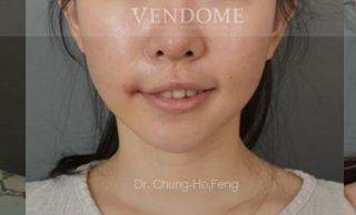 療程效果因人而異，28歲的Y小姐，在做完削骨手術後的第三年，始終覺得臉頰肉垂垂的，嘴角還不對稱，上圖是Y小姐在做完臉部年輕化拉皮手術後6個月、術後10個月追蹤