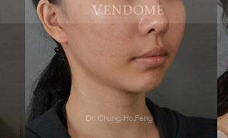 療程效果因人而異，28歲的Y小姐，在做完削骨手術後的第三年，始終覺得臉頰肉垂垂的，嘴角還不對稱，上圖是Y小姐在做完臉部年輕化拉皮手術後6個月、術後10個月追蹤