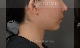 療程效果因人而異，28歲的Y小姐，在做完削骨手術後的第三年，始終覺得臉頰肉垂垂的，嘴角還不對稱，上圖是Y小姐在做完臉部年輕化拉皮手術後6個月、術後10個月追蹤