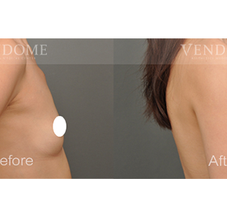 療程效果因人而異，上圖為該案例實際進行果凍矽膠隆乳手術後之成效